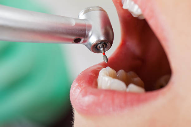 Best Knocked-Out Tooth (Avulsed Tooth) Treatment in Chesapeake, WV
